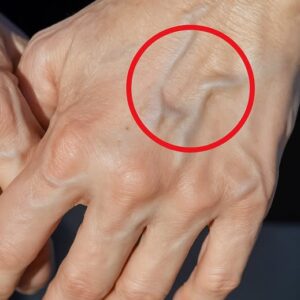 When Your Veins Start Sending a Warning…